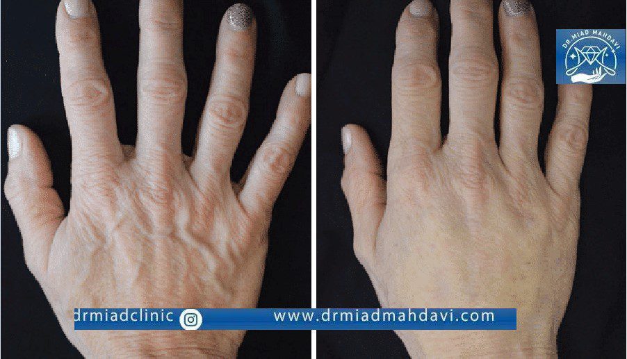 فیلر بادی چیست؟ شرح مزایا، معایب و هزینه 4 نتیجه تزریق فیلر بدن