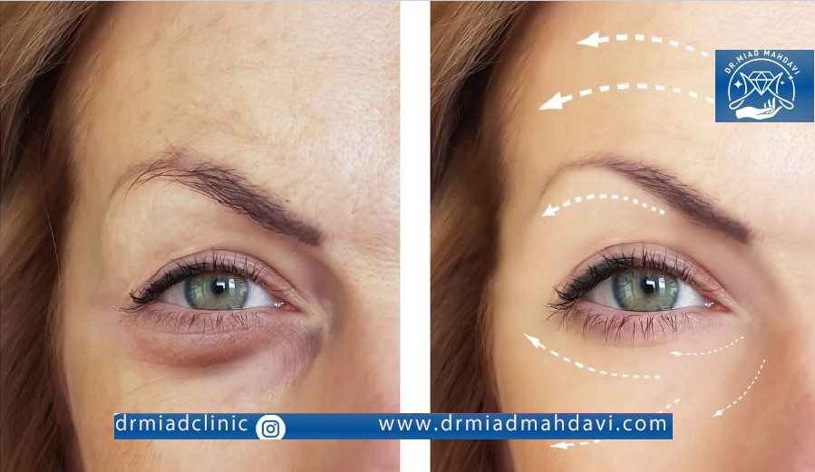 نتیجه فوق العاده قبل و بعد از تمدید بوتاکس زیر چشم در مراکز معتبر