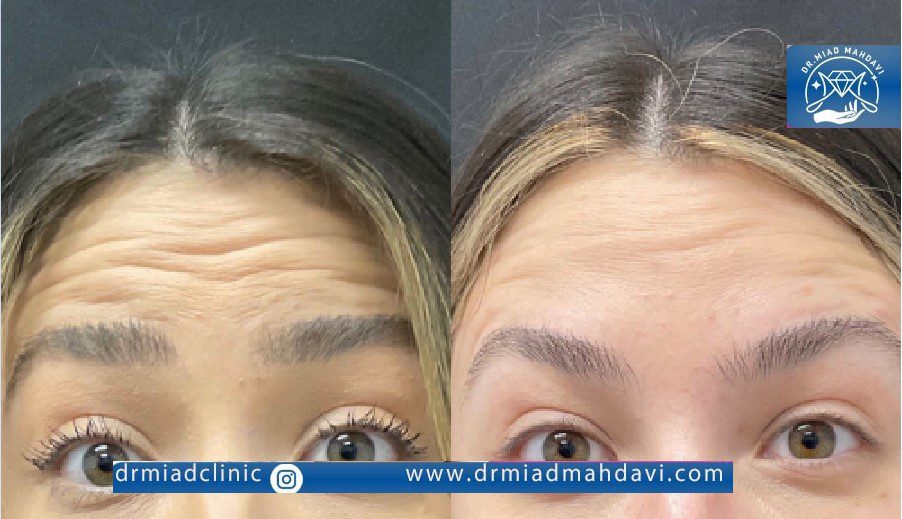 نتیجه حاصل از ترمیم بوتاکس