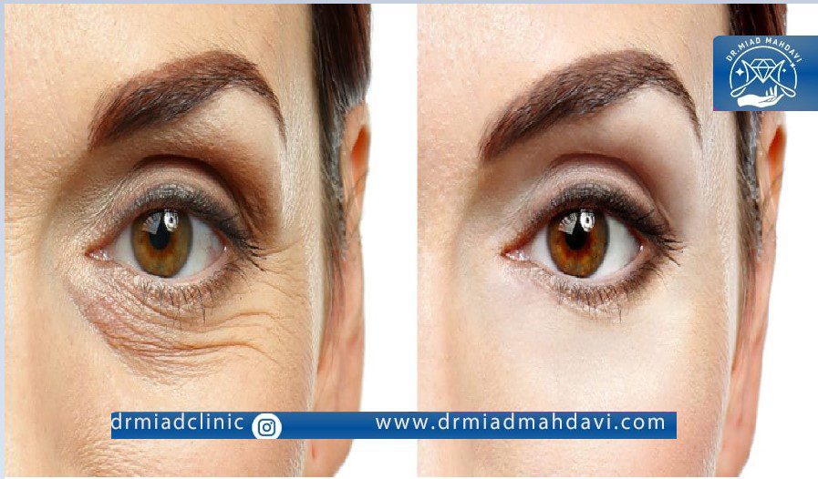 تاثیر فیلر زیر چشم روی سیاهی و چین و چروک های چشمی
