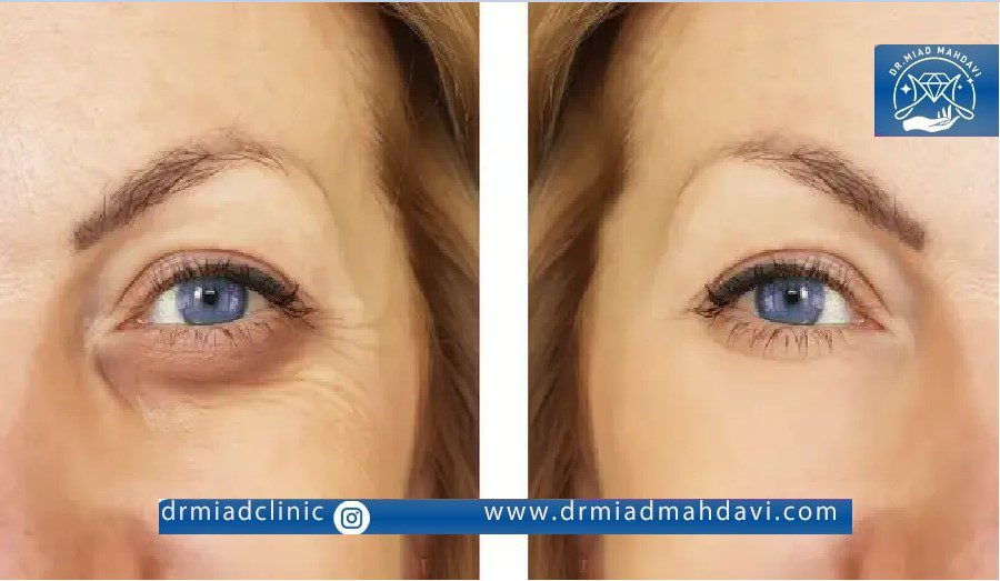 تاثیر تزریق فیلر زیر چشم روی جوانسازی پوست و حذف چروک
