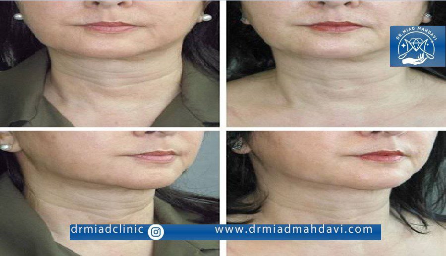 تاثیر مزوبوتاکس روی جوان سازی پوست و حذف چین و چروک گردن