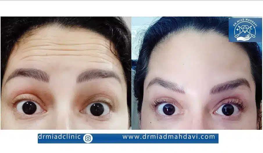 تفاوت بوتاکس و مزوبوتاکس در چیست؟+ هزینه مزوبوتاکس 4 تاثیر بوتاکس و مزوبوتاکس روی چروک های پوستی و درمان آن ها