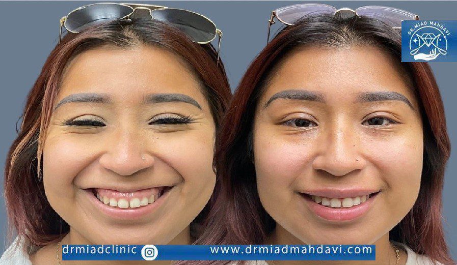 عکس بوتاکس لبخند لثه ای