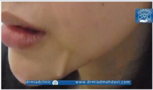 پارگی نخ لیفتینگ در ناحیه گونه و چانه| عوارض لیفت صورت با نخ