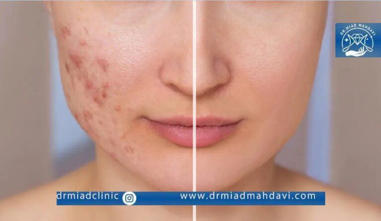 عکس قبل و بعد سابسیژن| عوارض سابسیژن