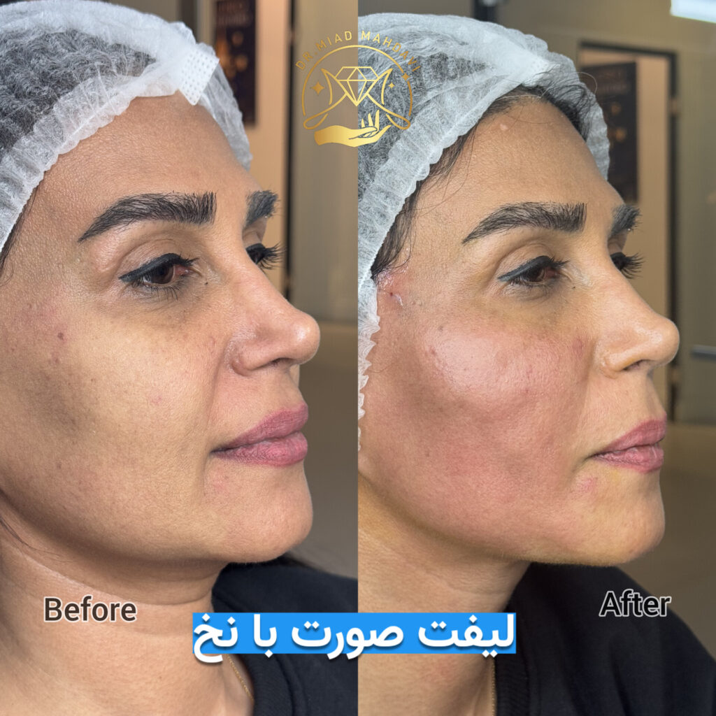 لیفت صورت با نخ | دکتر میعاد مهدوی