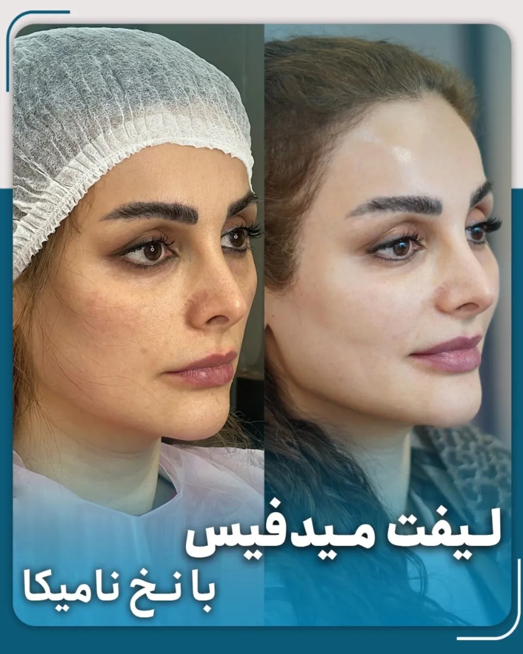 عکس قبل و بعد لیفت صورت با نخ نامیکا