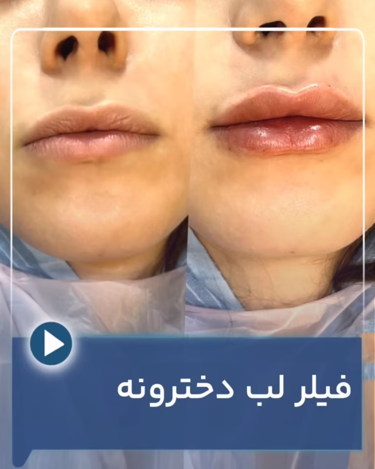 عکس قبل و بعد تزریق فیلر لب دخترونه