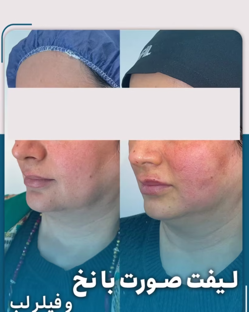عکس قبل و بعد لیفت صورت با نخ اپتوس و تزریق فیلر لب