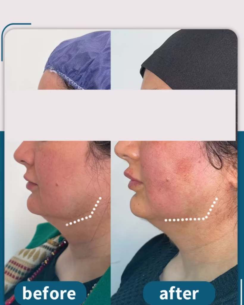 عکس قبل و بعد لیفت صورت با نخ اپتوس و تزریق فیلر لب