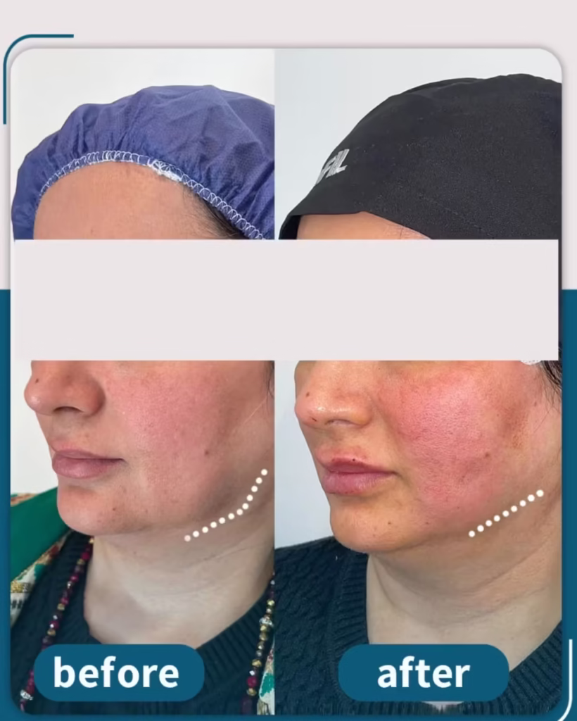 عکس قبل و بعد لیفت صورت با نخ اپتوس و تزریق فیلر لب