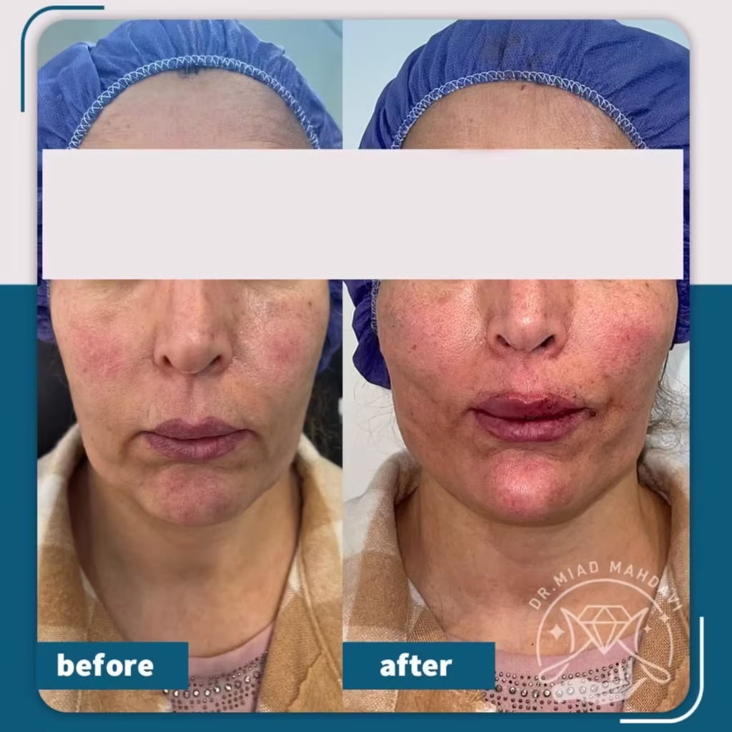 عکس قبل وبعد لیفت صورت با نخ اپتوس و تزریق فیلر لب