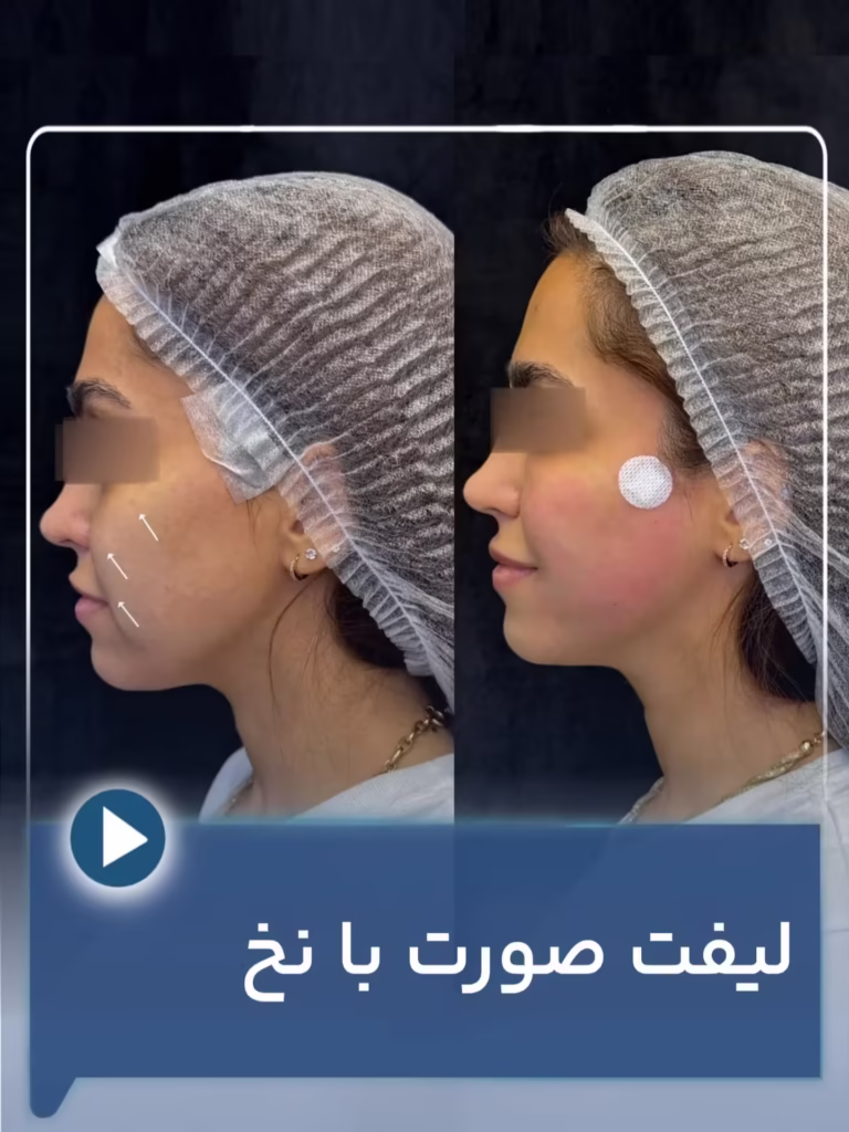 عکس قبل و بعد لیفت صورت با نخ 01