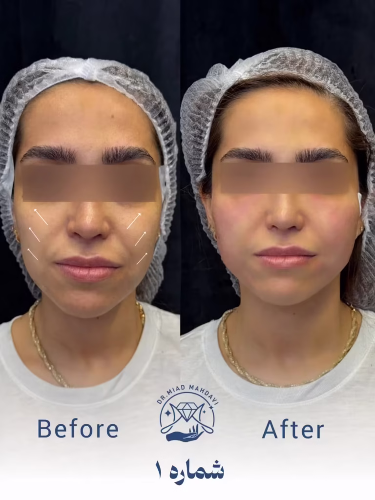 عکس قبل و بعد لیفت صورت با نخ 01