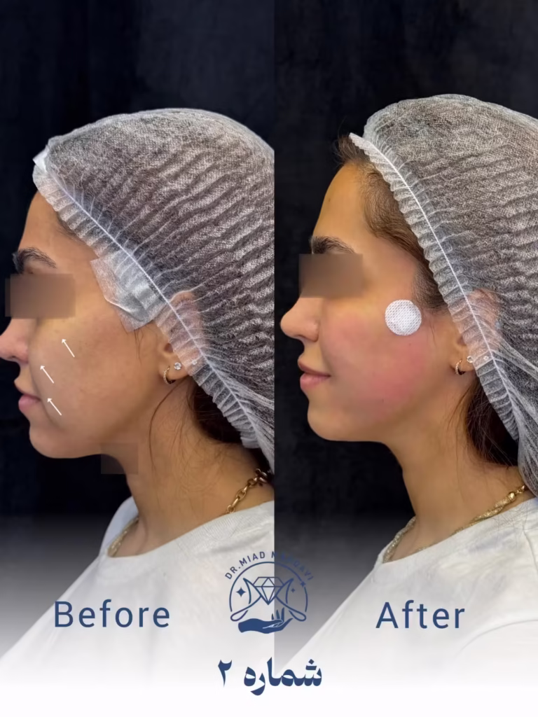 عکس قبل و بعد لیفت صورت با نخ 01