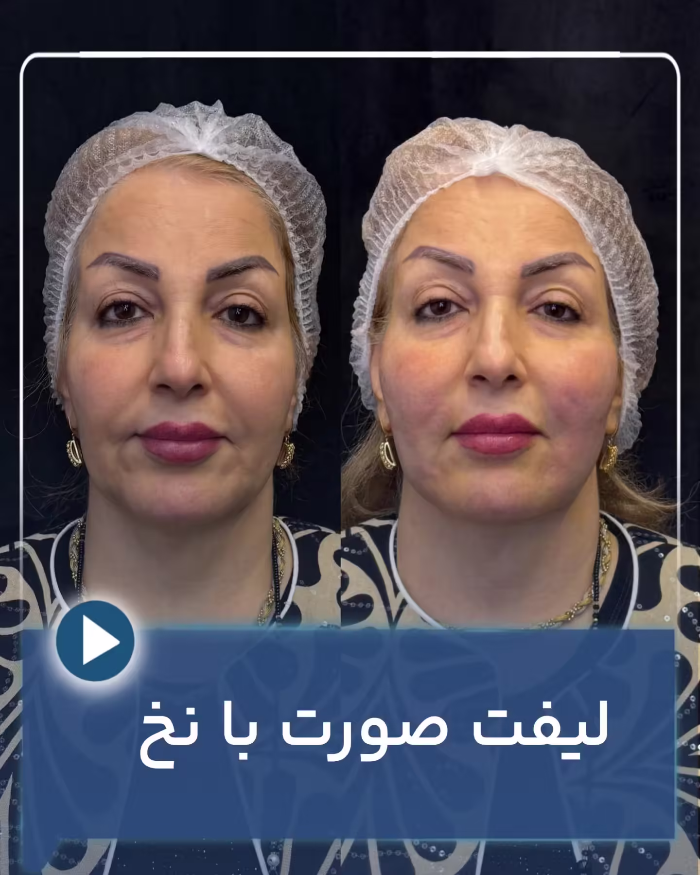عکس قبل و بعد لیفت صورت با نخ 01