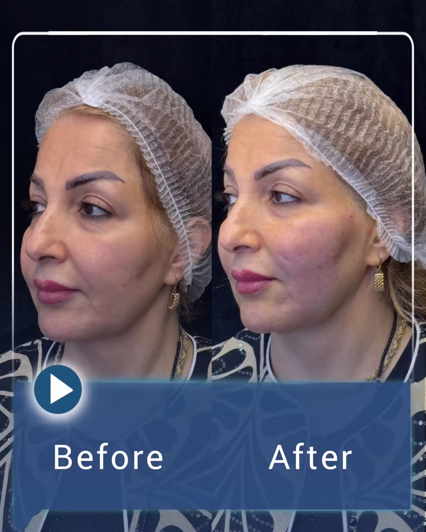 عکس قبل و بعد لیفت صورت با نخ 01