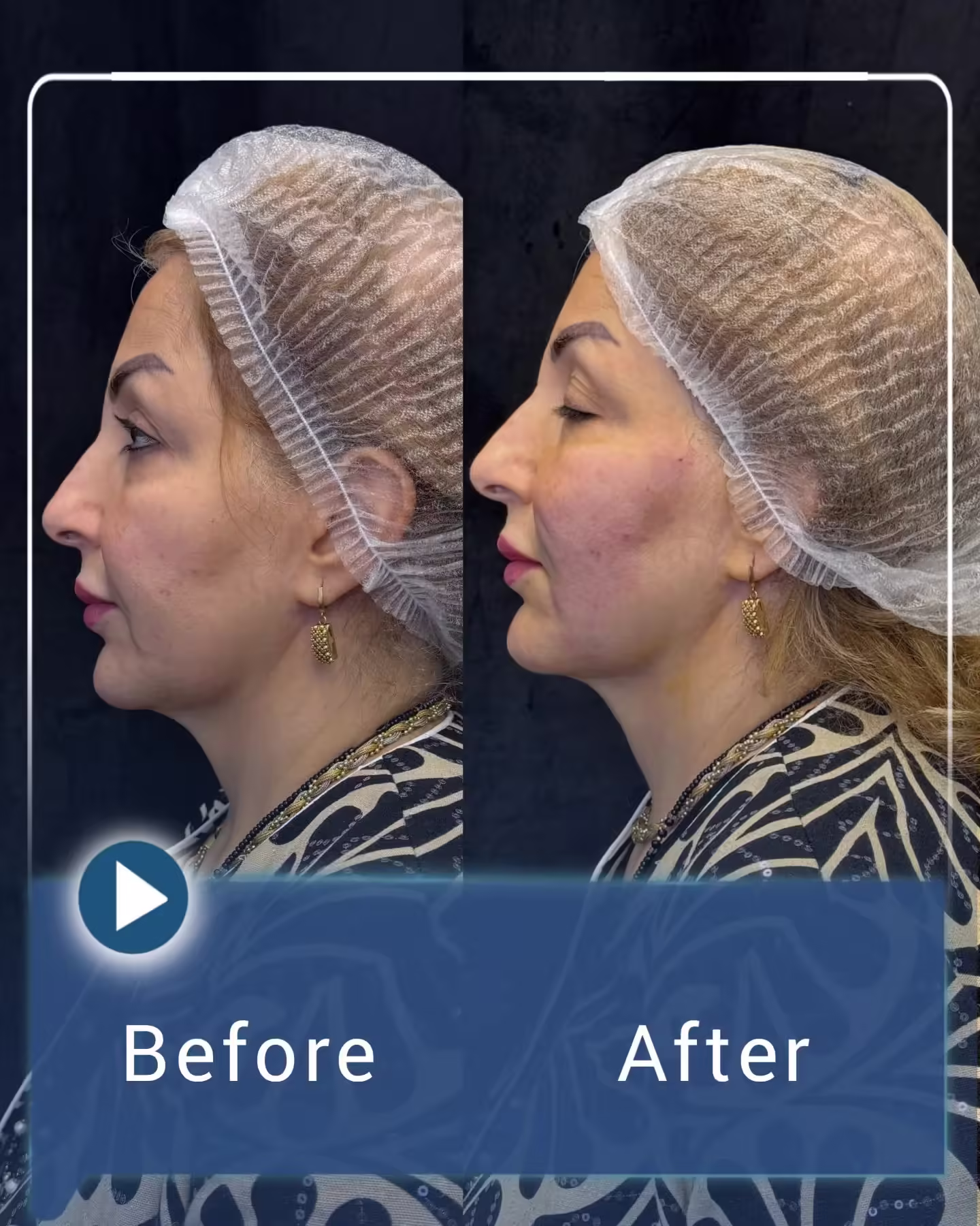 عکس قبل و بعد لیفت صورت با نخ 01