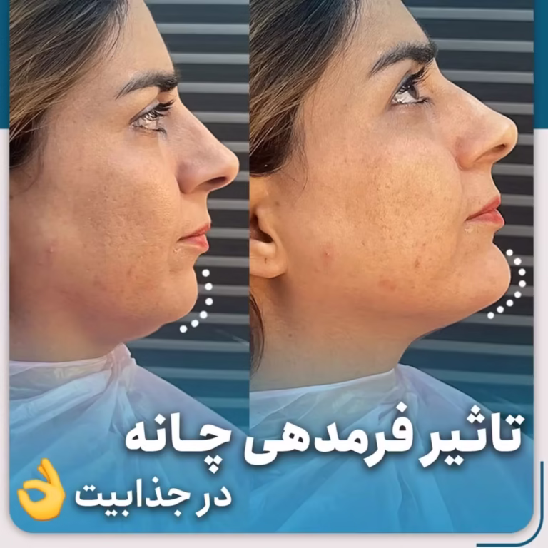 عکس قبل و بعد تزریق فیلر چانه