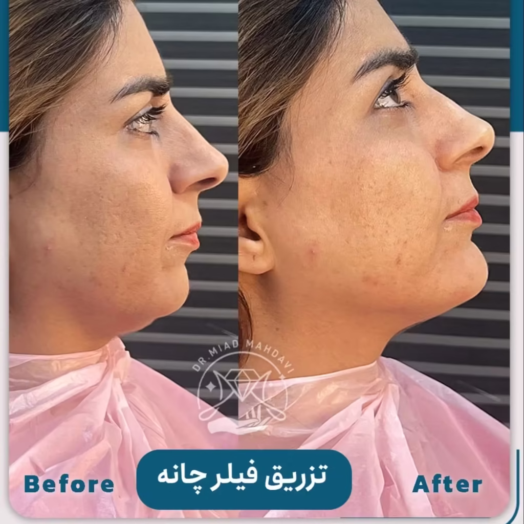 عکس قبل و بعد تزریق فیلر چانه