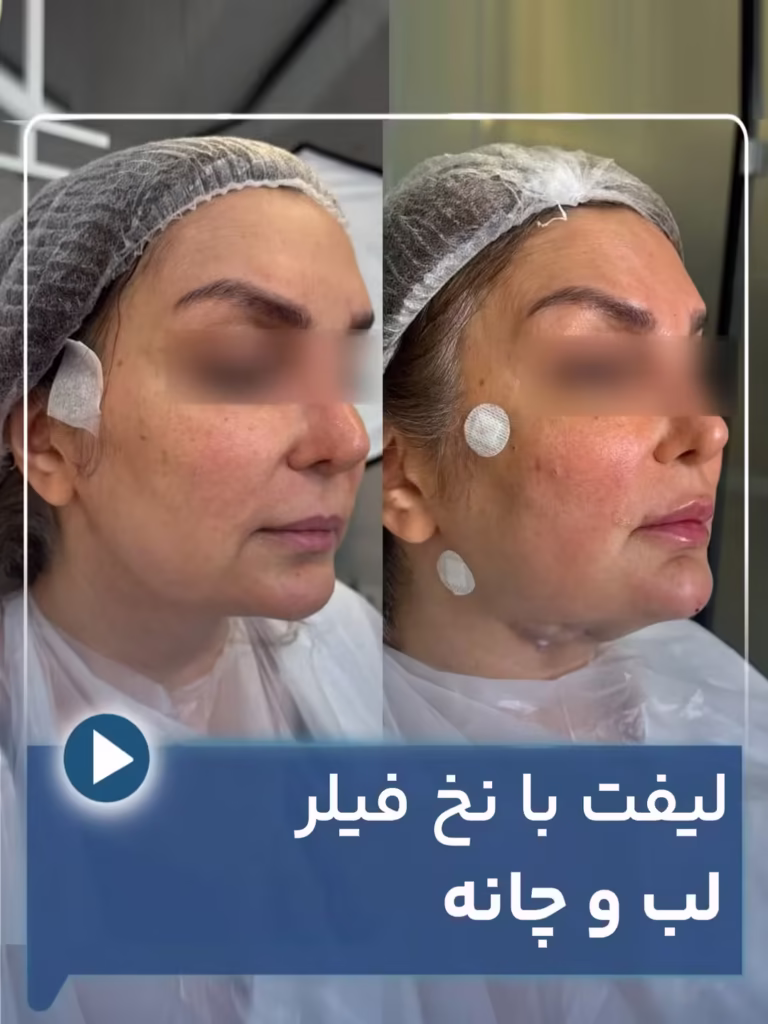 عکس قبل و بعد لیفت با نخ فیلر لب و چانه