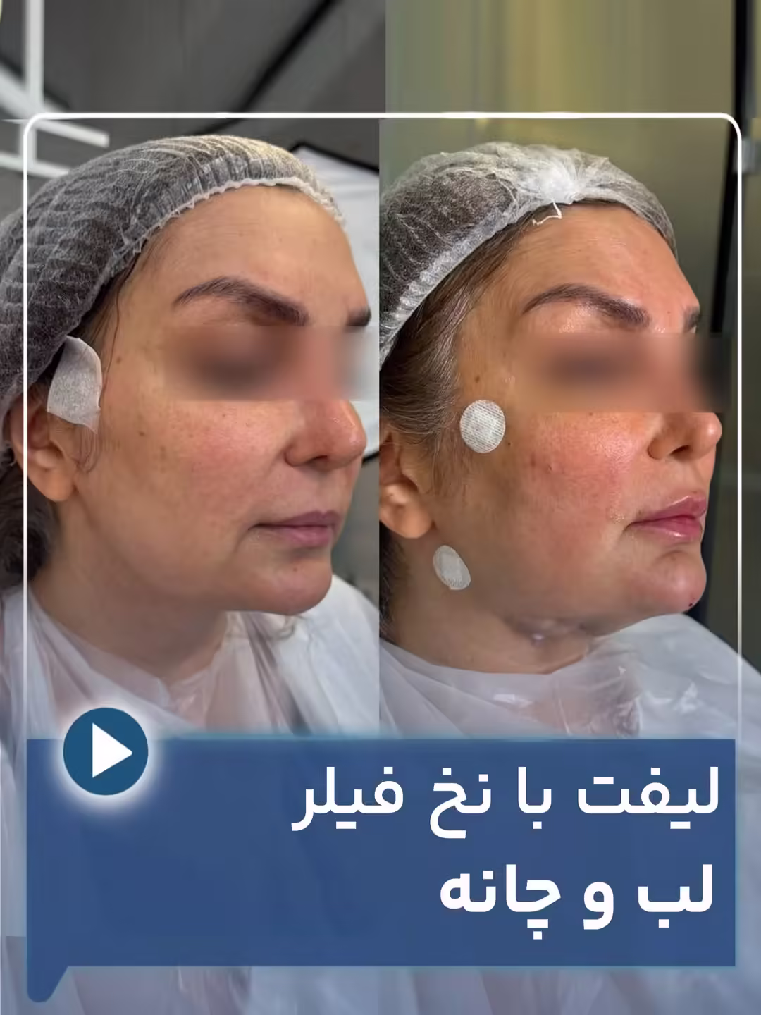 عکس قبل و بعد لیفت با نخ فیلر لب و چانه