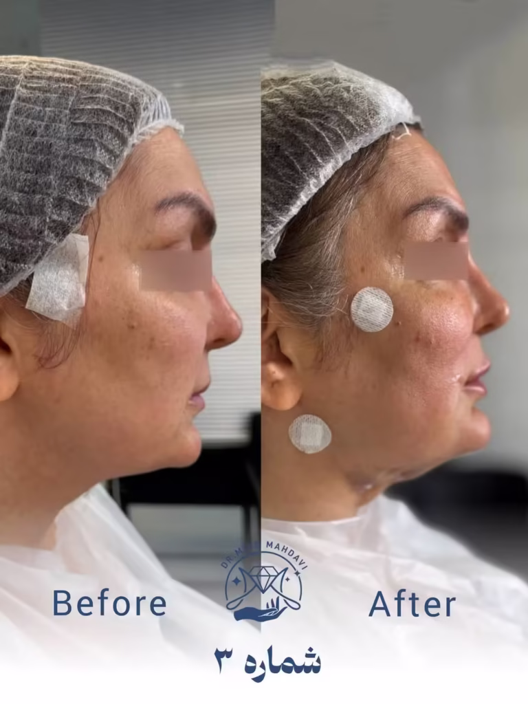 عکس قبل و بعد لیفت با نخ فیلر لب و چانه