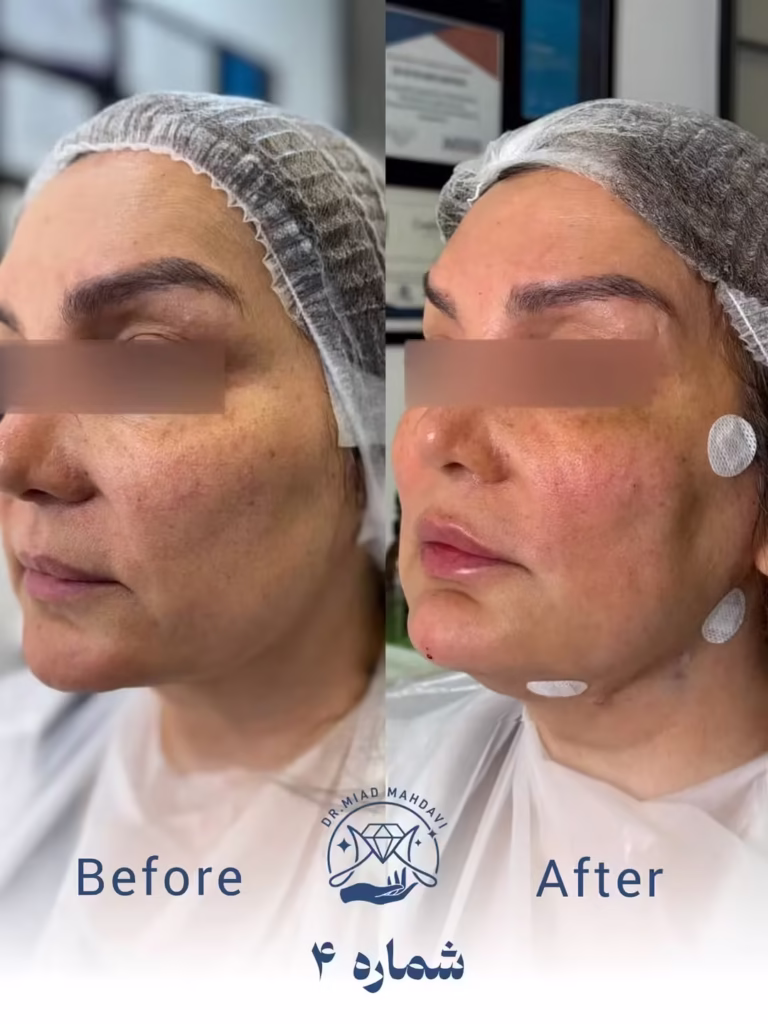عکس قبل و بعد لیفت با نخ فیلر لب و چانه
