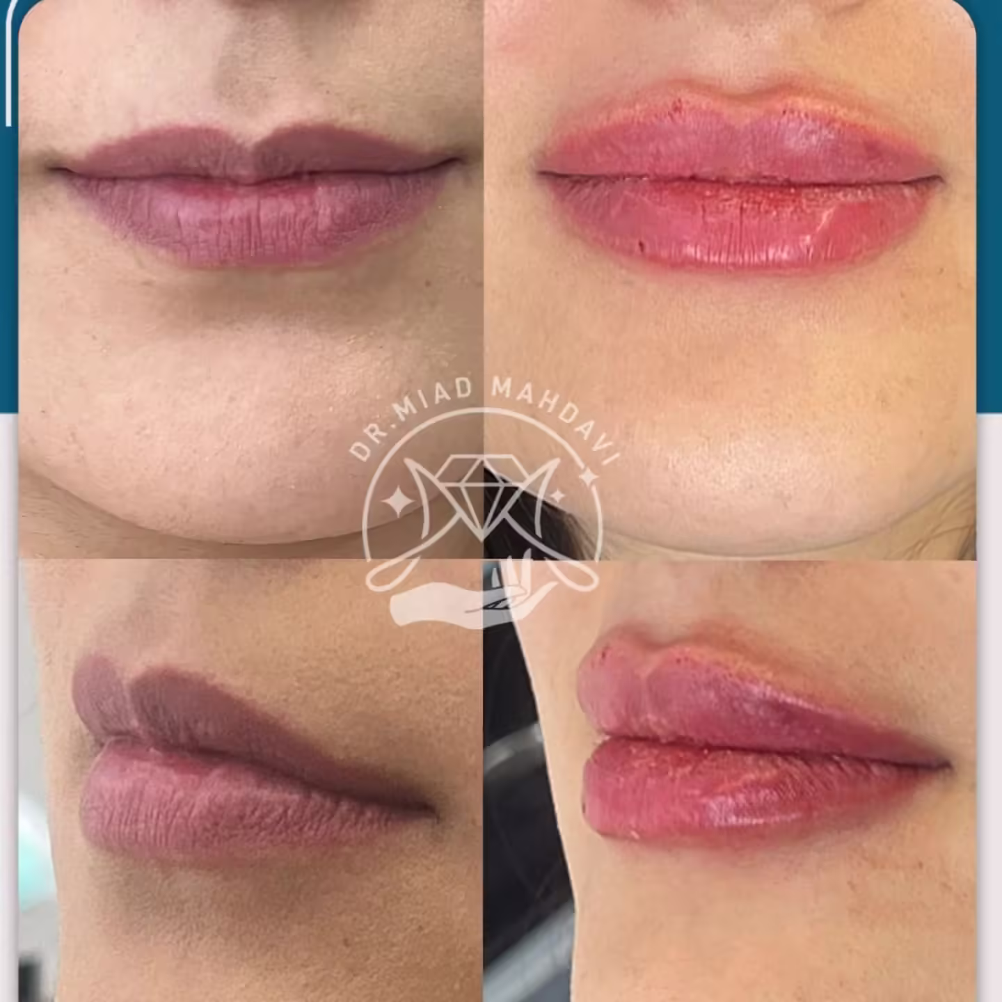 عکس قبل و بعد تزریق فیلر لب به سبک دکتر میعاد مهدوی