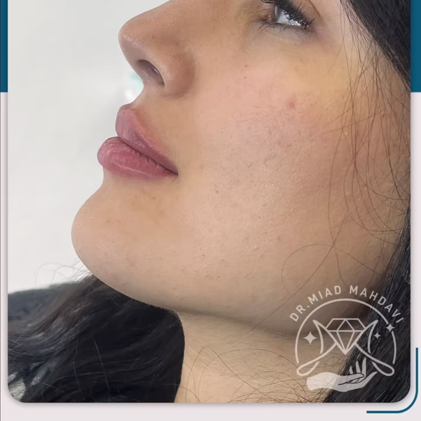 عکس قبل و بعد تزریق فیلر لب به سبک دکتر میعاد مهدوی