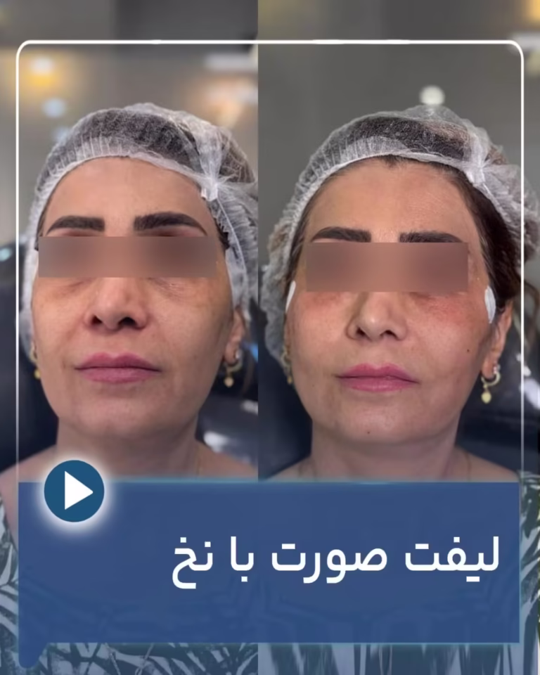 عکس قبل و بعد لیفت میدفیس با نخ