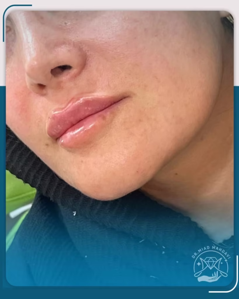 عکس قبل و بعد فیلر لب مدل نچرال