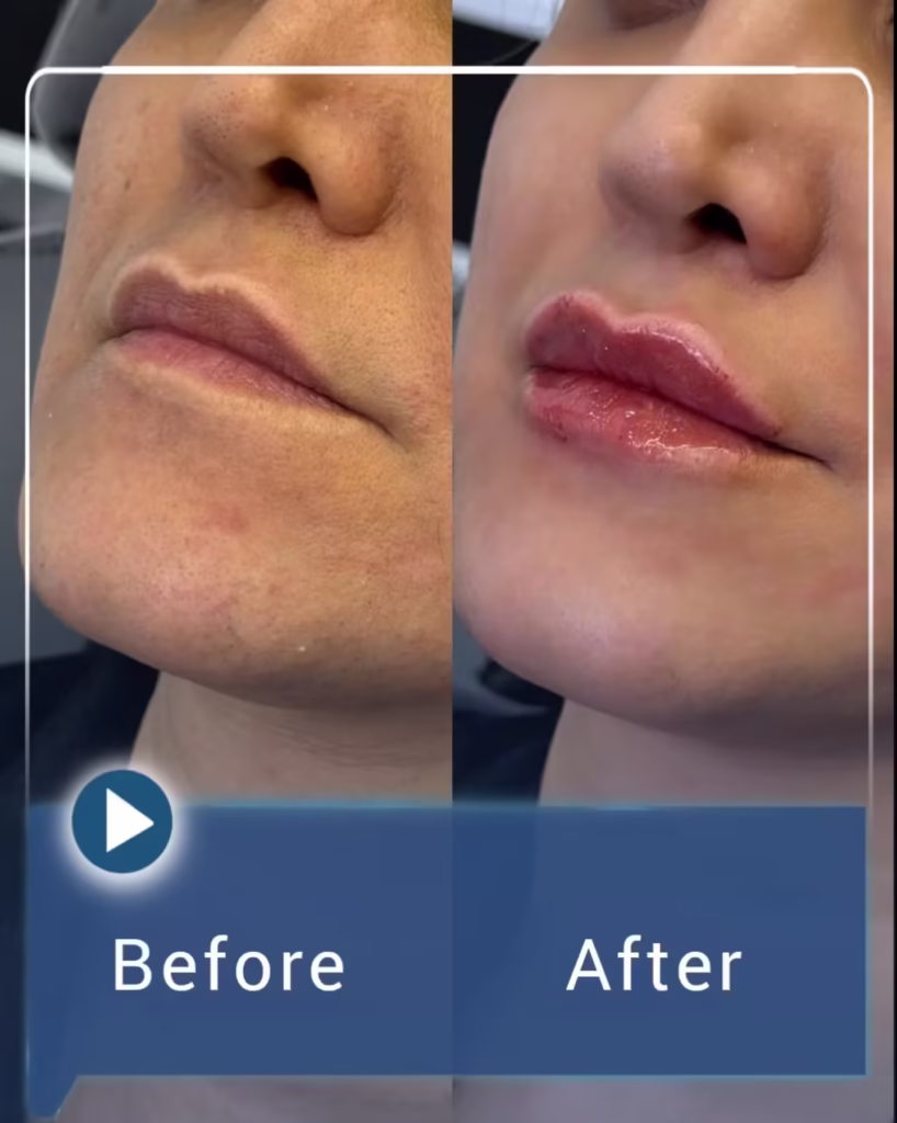 عکس قبل و بعد تزریق فیلر لب به سبک نچرال 02