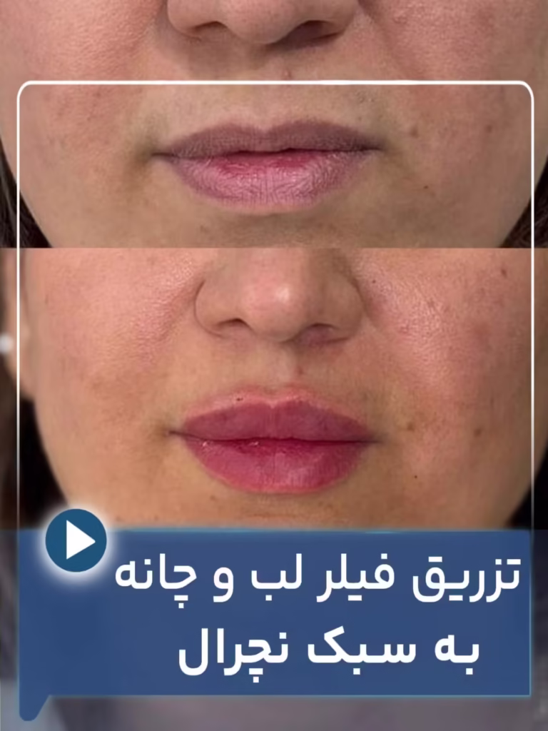 عکس قبل و بعد تزریق فیلر لب به سبک نچرال 02