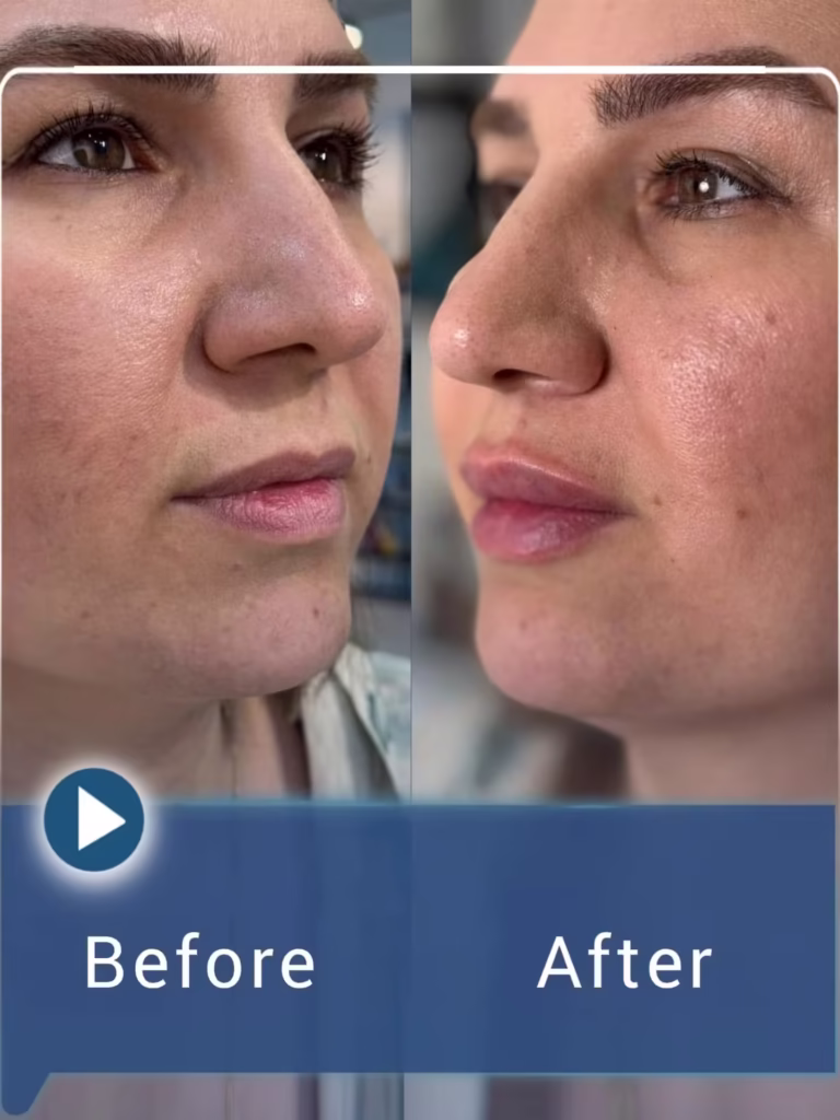 عکس قبل و بعد تزریق فیلر لب به سبک نچرال 02