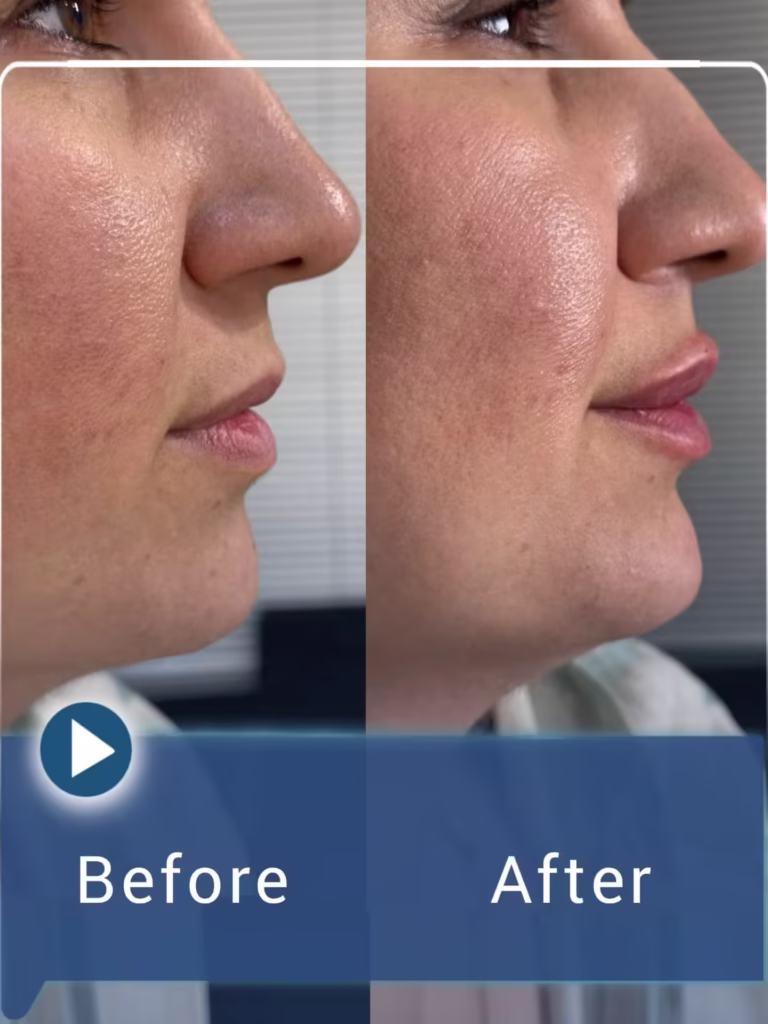 عکس قبل و بعد تزریق فیلر لب به سبک نچرال 02