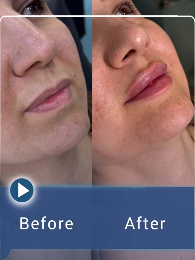 عکس قبل و بعد تزریق فیلر لب به سبک نچرال 02