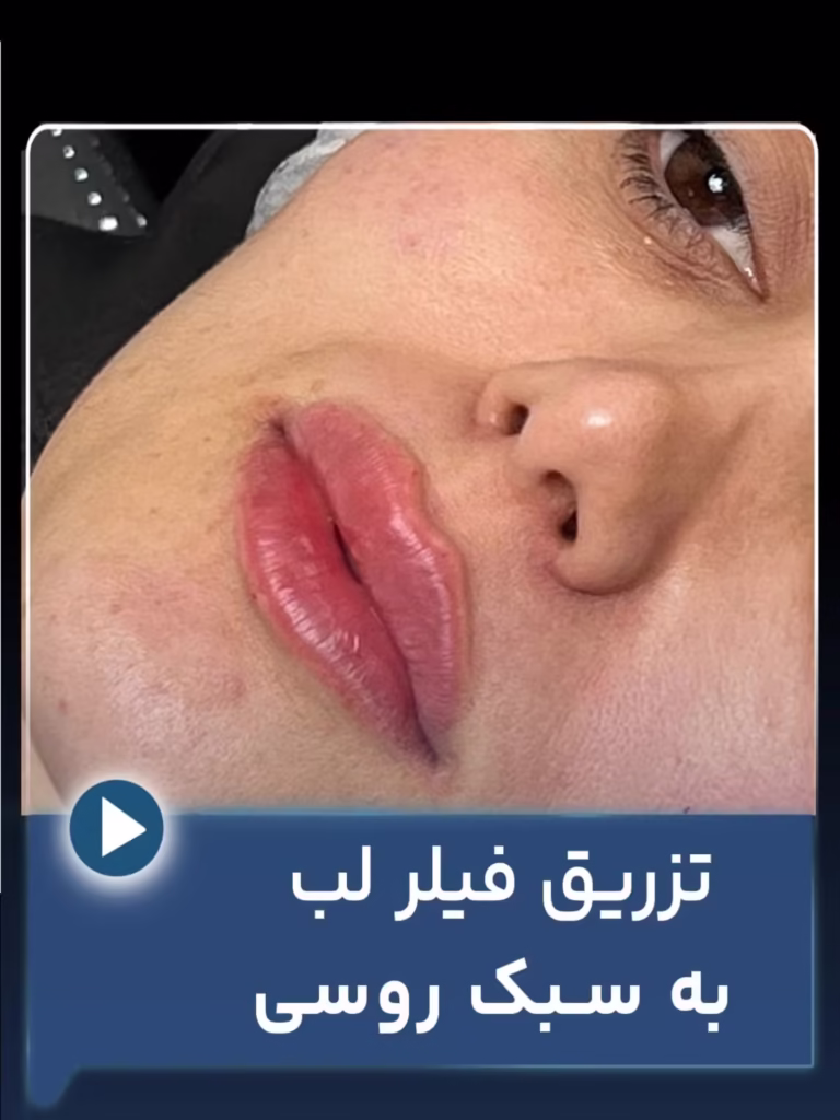 عکس قبل و بعد تزریق فیلر لب به سبک روسی