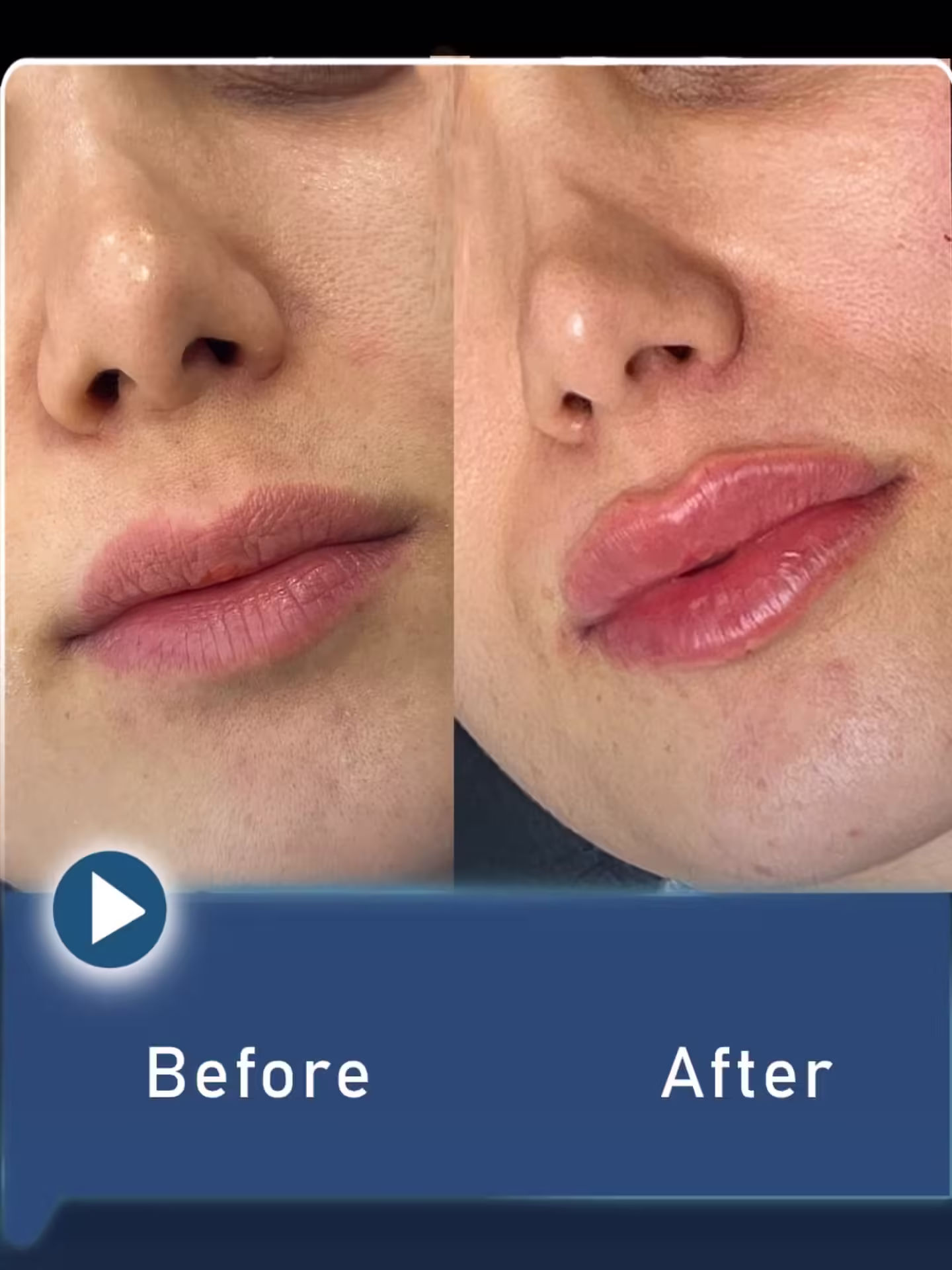 عکس قبل و بعد تزریق فیلر لب به سبک روسی