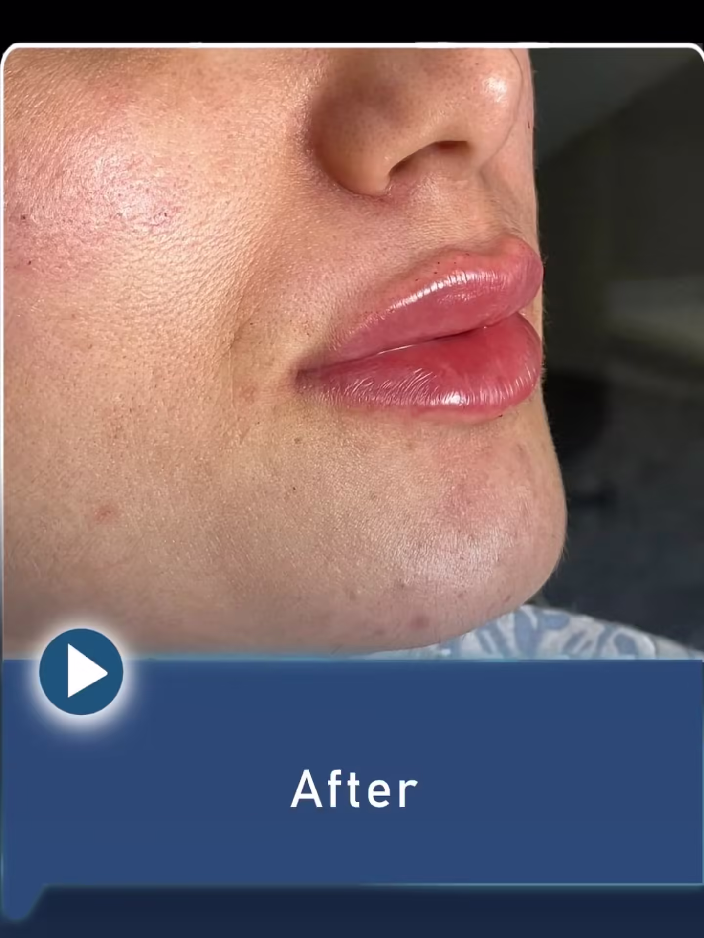 عکس قبل و بعد تزریق فیلر لب به سبک روسی