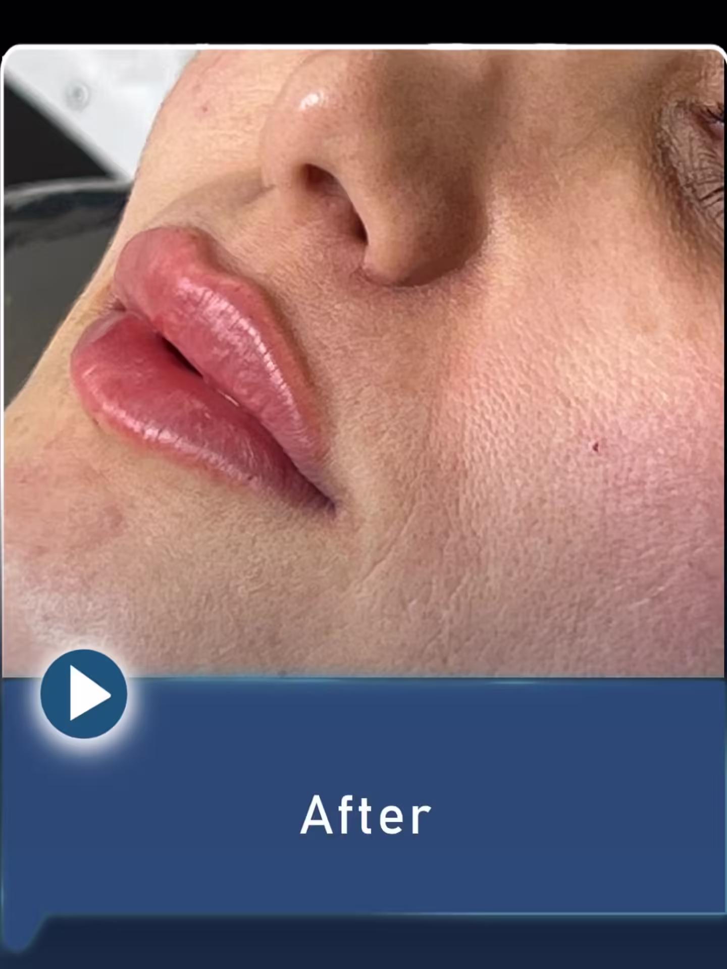 عکس قبل و بعد تزریق فیلر لب به سبک روسی