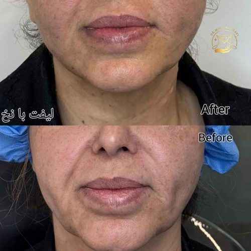 لیفت با نخ یا تزریق ژل لیفت با نخ بهتره یا تزریق ژل
